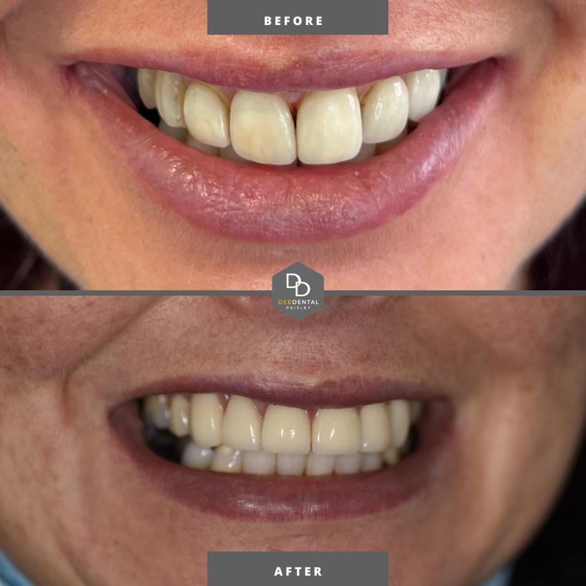 Transform Your Smile with Enlighten Teeth Whitening